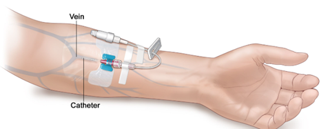 Catheter rework Catheter rework